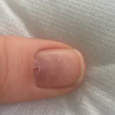 Loch Im Nagelbett Gesundheit Und Medizin Verletzung Nagel