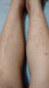 Allow them to heal on their own. What Is The Cheapest And Most Effective Way To Remove Leg Scars That Resulted From Picking Ingrown Hairs Photos