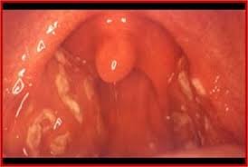 Image result for Tonsillitis