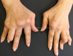 Its a tear to the tendon that bends your finger (specifically called the flexor digitorum this injury got the name jersey finger because rugby players would get their fingers caught in an opponents jersey while trying to tackle them and the pull. Boutonnerie Deformity Mallet Finger Jersey Finger Flashcards Quizlet