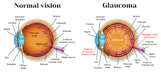 But blindness from glaucoma can often be prevented with early treatment. What Is Glaucoma Learn About Glaucoma Glaucoma Resources