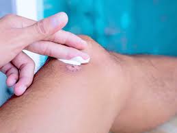 Keloid on a girl's earlobe. How To Get Rid Of Keloids Treatments And Home Remedies