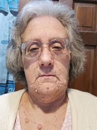 NF1 and Malignant Peripheral Nerve Sheath Tumor Experience