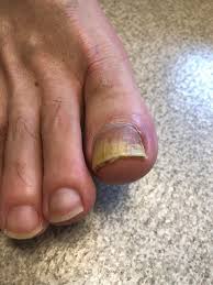 Image result for Yellow nail syndrome feet
