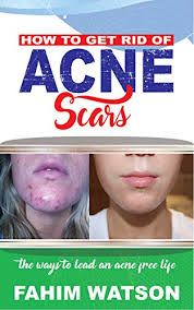 Visit discovery health to learn about getting rid of acne on your back. Amazon Com How To Get Rid Of Acne Scars The Ways To Lead An Acne Free Life Ebook Watson Fahim Kindle Store