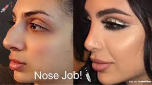 Here you can view actual before and after plastic surgery photographs submitted by asps member surgeons. My Nose Job Plastic Surgery Tell All Sadiaslayy Youtube
