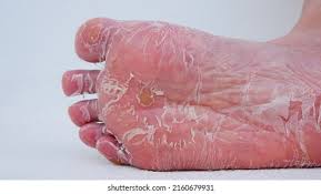 Image result for Anhidrosis