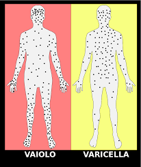 L'infezione naturale è stata eradicata. File Vaiolo Vs Varicella Svg Wikimedia Commons