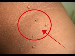 5) boleh juga 'tutup' love bite tersebut dengan menggunakan 'concealer' yang sama warna dengan kulit. Pin Di Masakan Sehari Hari