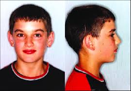 a. Hyperflexion-full face and profile.