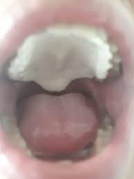Nip the potential for oral cancer in the bud by knowing these telltale signs: Bumps On Back Of Tongue Reddit