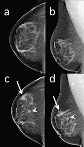 Do ct scans detect breast cancer? Contrast Enhanced Dedicated Breast Ct Detection Of Invasive Breast Cancer Preceding Mammographic Diagnosis Sciencedirect