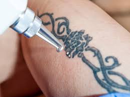 For the past 8 years i have been successfully and safely removing tattoos. Here S What You Can Do If You Don T Like Your Tattoo