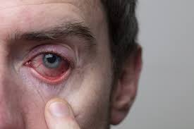 Image result for Uveitis