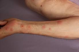 A strong, unpleasant, musty odor like that of a wet towel is another common bed bug symptom. How Do You Know If Your Have Bed Bugs In Your Home Wicked Bedbugs