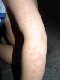 Image result for vyrážka u dětí