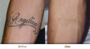 The technology is based on the belief that there should be no compromise on the ones who buy the product. 9 Best Laser Tattoo Removal Treatments Styles At Life