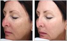 Image result for what is halo treatment for acne