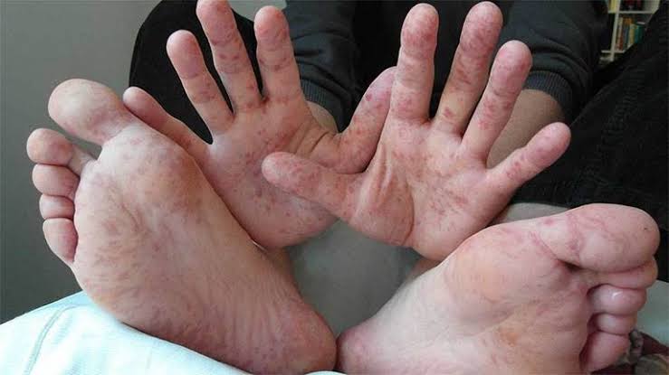 Viêm da bàn tay và bàn chân - Khoa Da Liễu Thẩm Mỹ Da - Bệnh viện Đại Học Y  Dược TPHCM