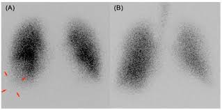 Image result for Ventilation Perfusion Scan