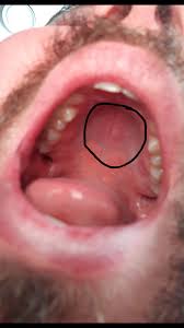 A bump on the roof of mouth can mean oral cancer, ulcers, some stds, allergies, canker sores etc. Bump On The Roof Of My Mouth Diagnoseme