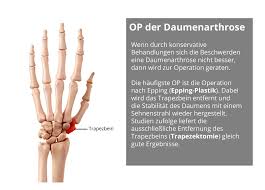Op Der Daumenarthrose Wie Lange Wird Man Krankgeschrieben