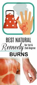 Learn The Best Home Remedy For 1st And 2nd Degree Burns Found In Most Home Kitchens And How And Why Home Remedies For Burns Burn Remedy Natural Home Remedies