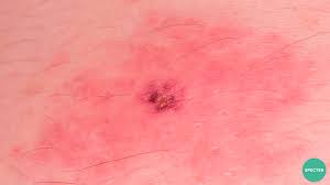 Image result for infected tick bite