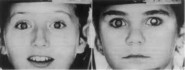 Negative Bruckner test. The brightness in the fundus reflexes is the...