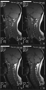 Image result for Syringomyelia