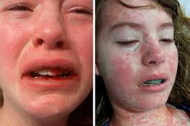 Internada há dez semanas, adolescente enfrenta doença misteriosa após  picada de mosquito