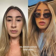 E esse ANTES e esse DEPOIS?? 😍👃🏼 2 meses separam uma foto da outra e só  vai melhorando 🫶🏼💓 (fotos enviadas pela paciente) . . . Dra Bárbara  Castilho CROSP 148964 . . .