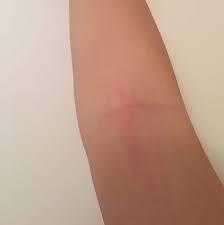 Er zeigt die entzündung einer lymphbahn an, die zu einer sepsis führen kann. Anfang Einer Blutvergiftung Arm
