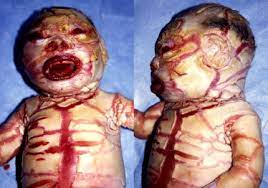 Or acute rupture • trauma. Facial Features In Harlequin Ichthyosis Clinical Findings About 4 Cases Sciencedirect