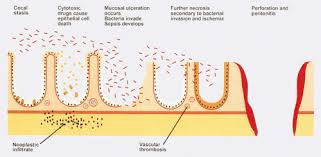 Image result for Neutropenic Colitis