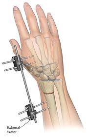 We did not find results for: Treating Wrist Fractures Saint Luke S Health System