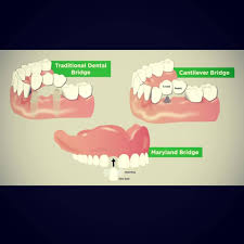 Entah karena dicabut, kecelakaan atau sebab yang lain. Fahri Dental Kepanjen Home Facebook
