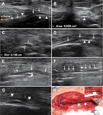 Fiance visa application form uk. The Efficacy Of Ultrasound For Visualizing Radial Nerve Lesions With Coexistent Plate Fixation Of Humeral Shaft Fractures Injury