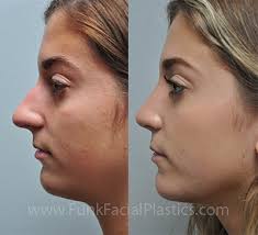 It depends on the extent of the surgery done, but these are questions you need to ask your surgeon. Rhinoplasty For A Bulbous Tip Wide Nasal Tip Surgery Funk Facial Plastic Surgery