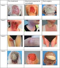 Basal cell carcinoma (bcc) develops when basal cells begin to grow out of control. Vismodegib For Giant Locally Advanced Basal Cell Carcinoma And Its Complex Position In Clinical Practice Jaad Case Reports