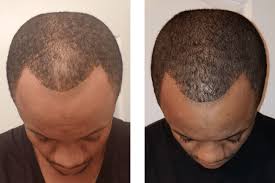 Association of ssris with hair loss is rare and limited to a few case reports. Hair Loss Treatment Products For Men Hims