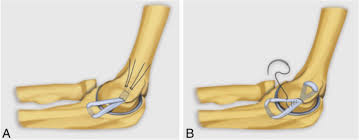 The ulna collateral ligament, on the medial side of the elbow, connects the ulna to the humerus. The Elbow Review Of Anatomy And Common Collateral Ligament Complex Pathology Using Mri Insights Into Imaging Full Text