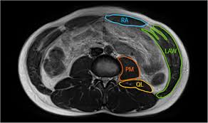 This group is made of three subgroups, with the group divisions occurring by location. Comparison Of Mri Cross Sectional Area And Functions Of Core Muscles Among Asymptomatic Individuals With And Without Lumbar Intervertebral Disc Degeneration Bmc Musculoskeletal Disorders Full Text
