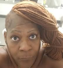 PRP and Juverderm fillers