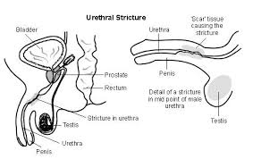 د موسي الحضيري ضيق مجرى البول تعريف قناة مجرى البول أو الاحليل Urethra عبارة عن أنبوب يبدأ من المثانة لينقل البول إلى خارج الجسم وعند الذكور نجد أن مجرى البول داخل القضيب