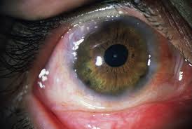Image result for Vernal Conjunctivitis