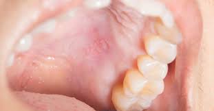 See oral surgeon for exam. Bump On The Roof Of The Mouth 12 Causes