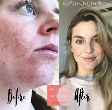 The skin condition results from blocked pores in the skin that cause infection and inflammation. Women Who Feel Ignored By Their Doctors Are Turning To An Instagram Tea Released By A Model