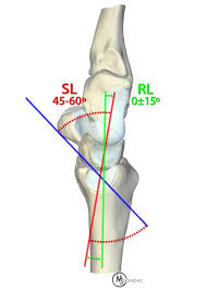 Image result for Scapholunate Dislocation
