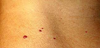 Tardive Hamangiome Blutschwammchen Ursachen Und Therapie